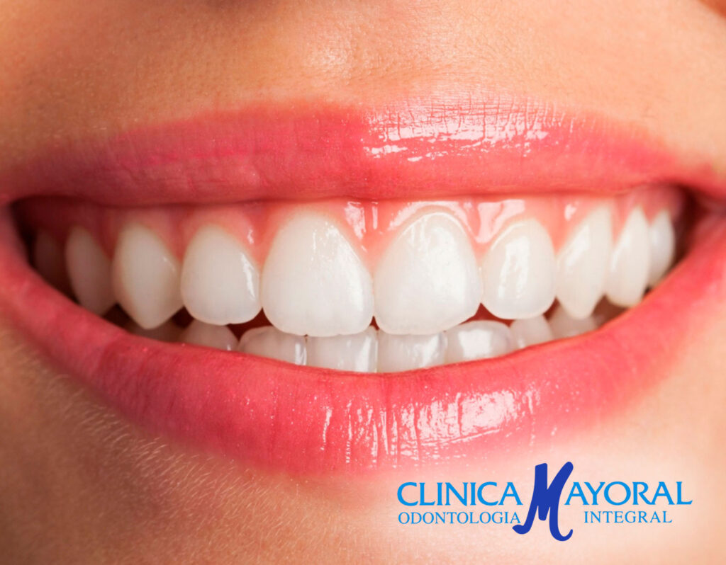 Tratamiento de odontología estética mínimamente invasiva y diseño de sonrisa en Clínica Mayoral Barcelona