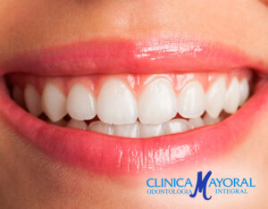 Tratamiento de odontología estética mínimamente invasiva y diseño de sonrisa en Clínica Mayoral Barcelona